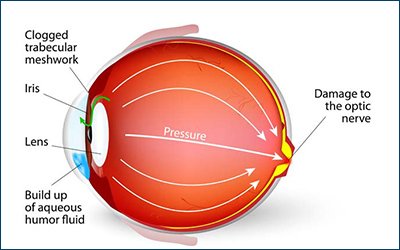 Glaucoma_Surgery